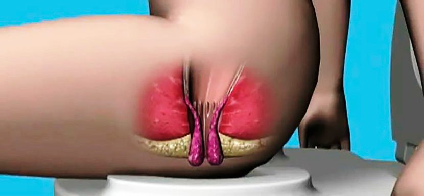 Что такое геморрой и как его лечить