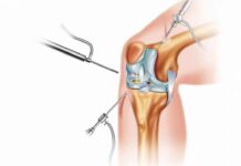 Артроскопия коленного сустава ребенку: показания и проведение