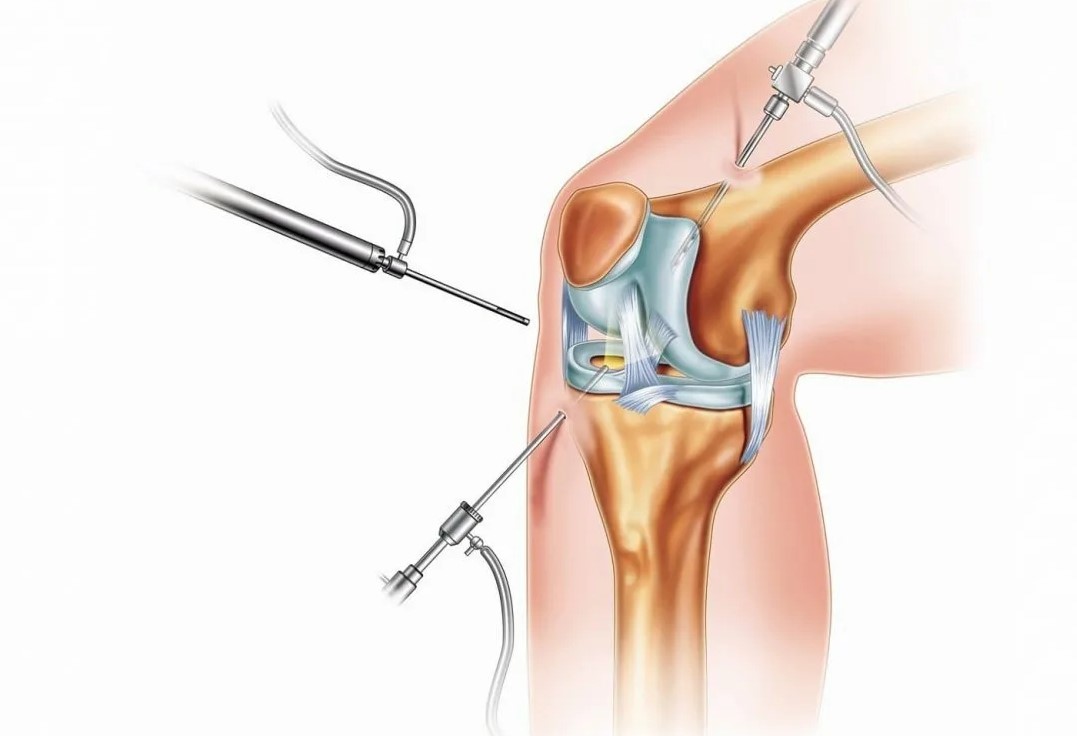 Артроскопия коленного сустава ребенку: показания и проведение