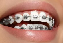 Как ставят брекеты