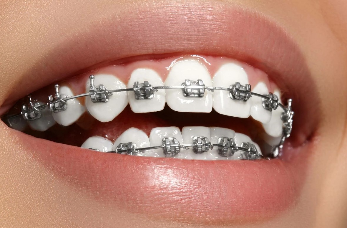 Как ставят брекеты