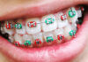 Особенности установки брекетов детям