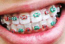 Особенности установки брекетов детям