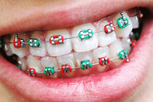 Особенности установки брекетов детям