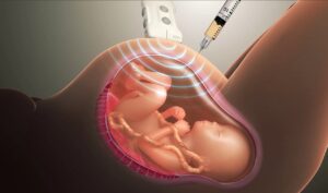 Что такое инвазивная пренатальная диагностика