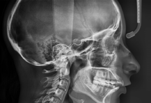 Телерентгенограмма — что за процедура и для чего она делается