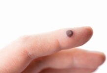 Бородавки — что за явление и способы борьбы с ними от Fillin