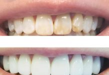 Реставрация зубов: важность и преимущества