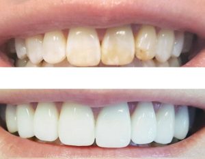 Реставрация зубов: важность и преимущества