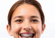 Что нужно чтобы поставить брекеты?