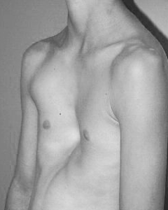 Воронкообразная деформация грудной клетки и методы ее лечения