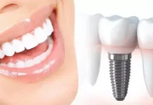 Имплантация зубов под ключ в Барселоне. Методы имплантации и стадии процедуры