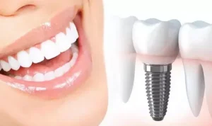 Имплантация зубов под ключ в Барселоне. Методы имплантации и стадии процедуры