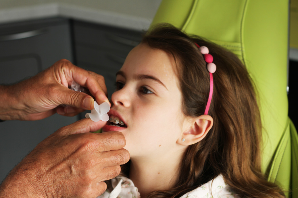 Миотрейнеры FroggyMouth: инновационный подход к лечению инфантильного глотания у детей