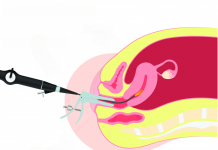 Гистероскопия: что это за процедура и как к ней подготовиться