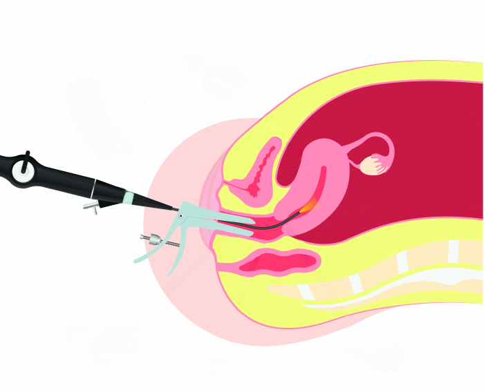 Гистероскопия: что это за процедура и как к ней подготовиться