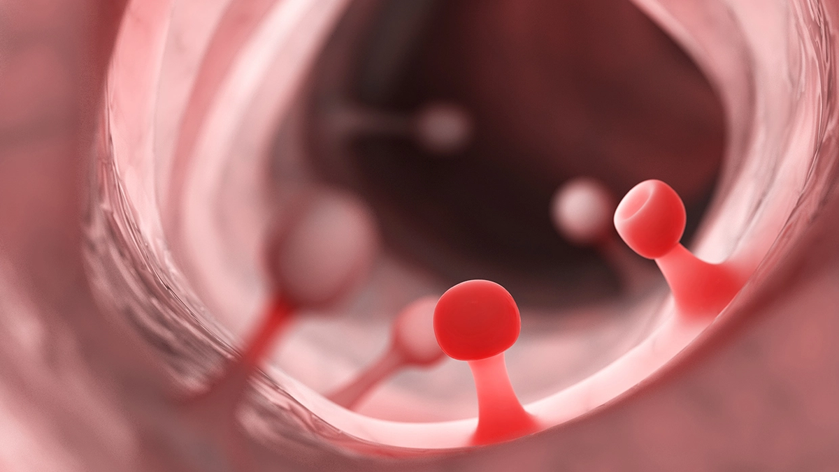 Полип шейки матки: что это такое и как его лечить