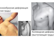 Заболевания грудной клетки у детей