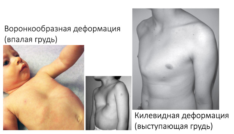 Заболевания грудной клетки у детей