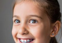 Этапы установки брекетов