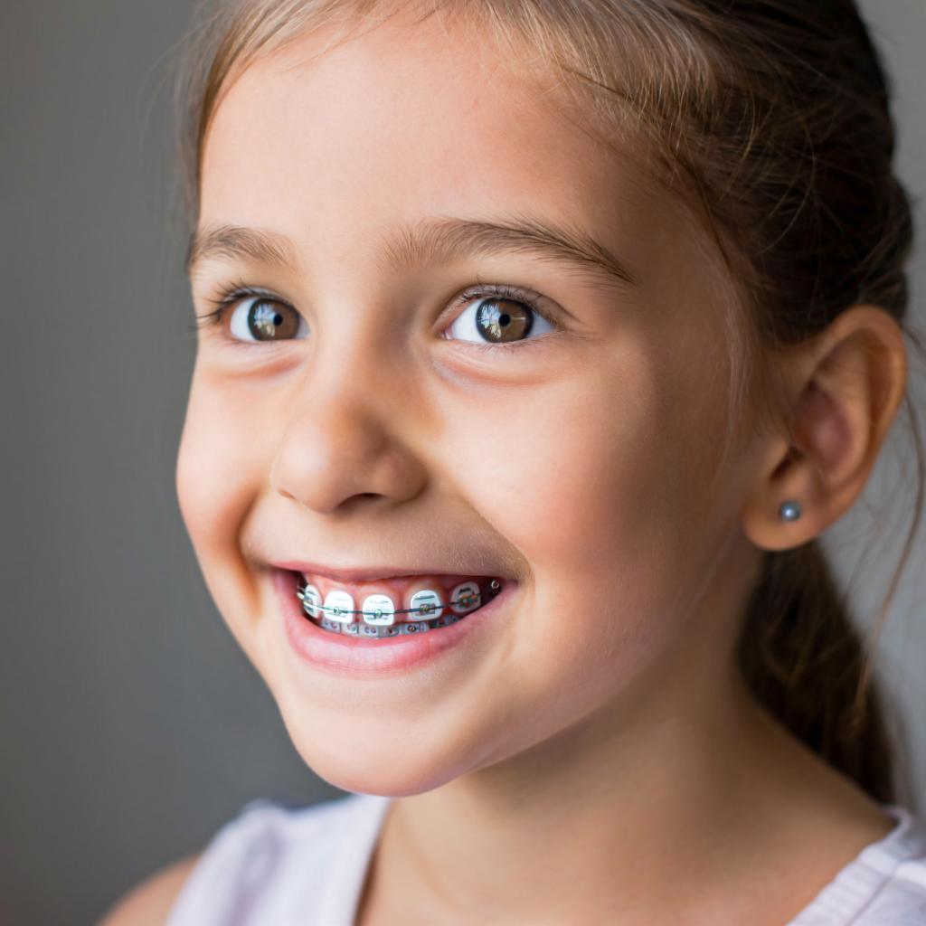 Этапы установки брекетов