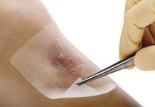 Как выбрать средство для заживления ран: руководство по быстрому и безопасному восстановлению