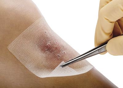 Как выбрать средство для заживления ран: руководство по быстрому и безопасному восстановлению