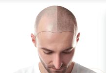 Показания для трансплантации волос