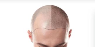 Показания для трансплантации волос