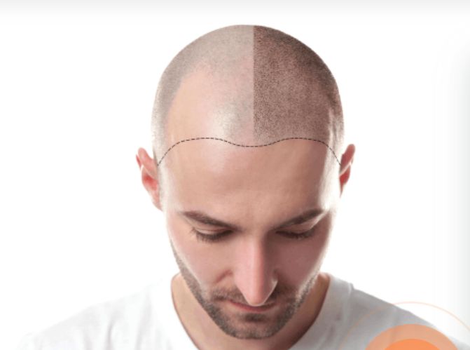 Показания для трансплантации волос